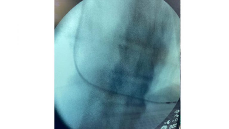 Caso Clínico Enfermedad del nodo Avance Cardiológico