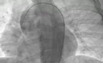 Disección espontanea  de arterias coronarias