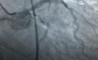 Caso clínico: Masculino 74 años edad, Disnea GII