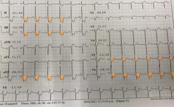Caso Clinico: Cardiopatía isquemica