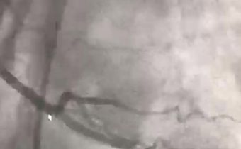 Caso clínico: Arritmia cardíaca