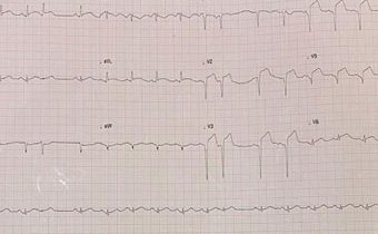 Caso Clínico: Infarto Agudo del Miocardio