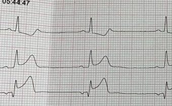 Caso Clínico: Cardiopatía Isquémica