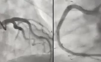 Cardiopatía isquemica