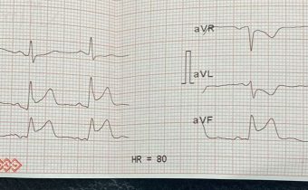 Caso Clínico: Infarto Agudo del Miocardio