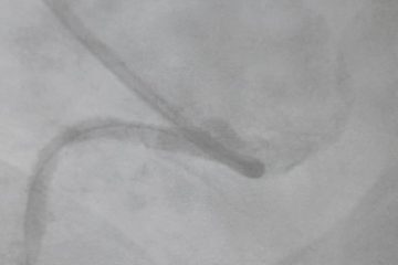 Caso clínico: Realización de  ACTP a la arteria CD