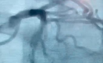 Caso clínico: Paciente masculino 72 años, Diabético Hipertenso