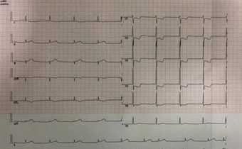 Caso Clínico: Infarto Agudo del Miocardio
