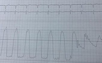 Caso Clínico: Estenosis Aórtica