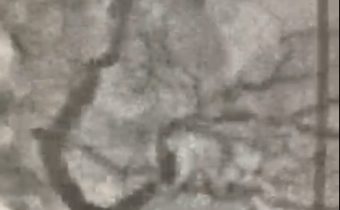 Caso clínico: Paciente masculino 80 años angina inestable hace 1 semana