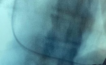 Caso Clínico: Enfermedad del nodo