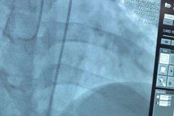 ¿Cuales son las arterias coronarias del corazón?