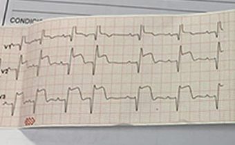 Caso Clínico: Cardiopatía Isquémica