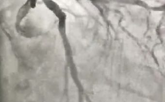 Nuevo episodio de angina