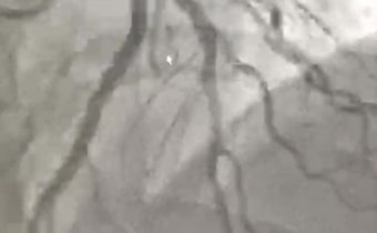 IAM anterior fibrinolizado