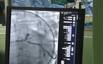 Tratamiento sin cirugía de corazón abierto de la enfermedad del tronco coronario