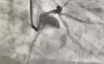 Paciente con diabetes: tuvo Infarto cara diafragmática