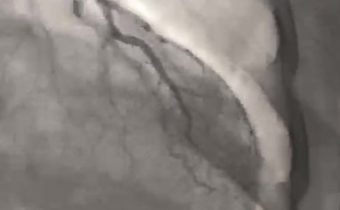 Caso Clinico: Angina típica